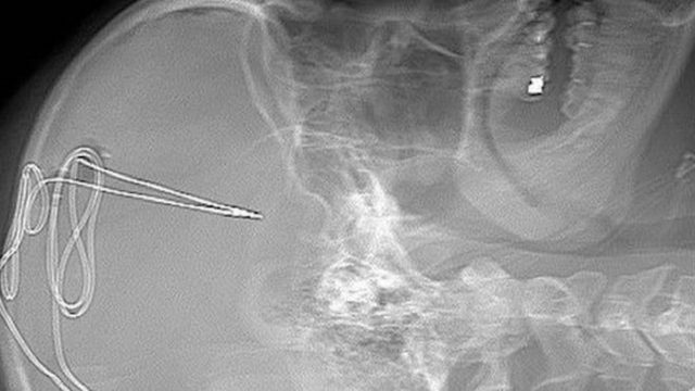 11/11/19 Marcapasos-Cerebral-Adicciones-Combatir/ radiografía