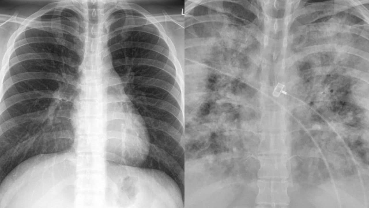 Así se ve los pulmones de alguien sin vacunar contra Covid-19