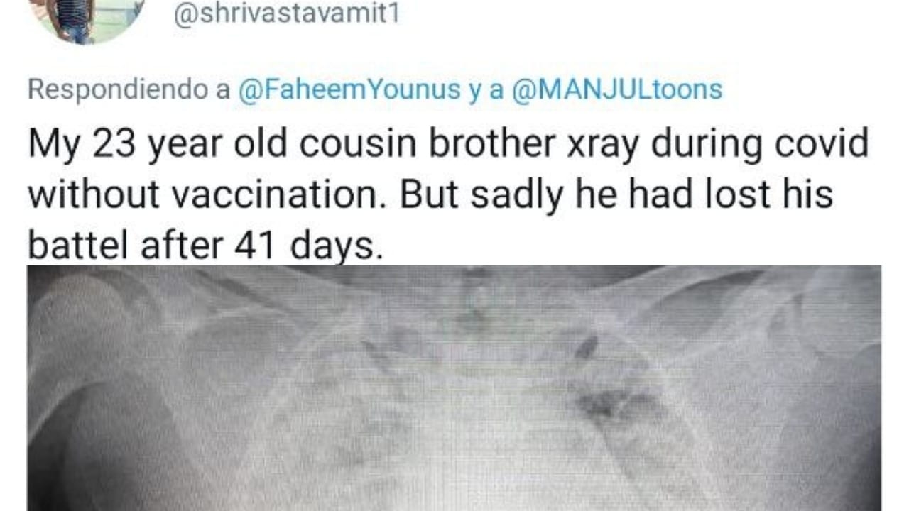 Covid-19 en pulmones sin vacunar