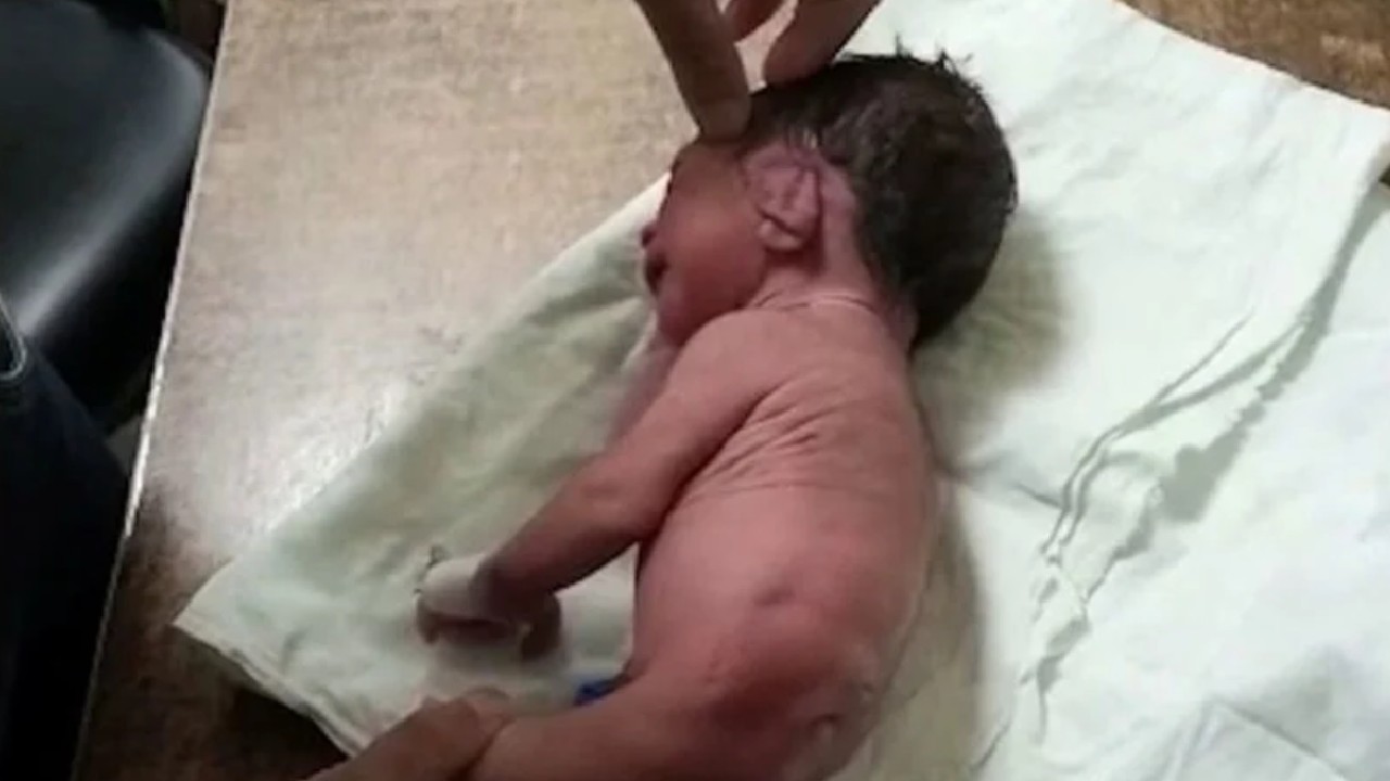 Bebé con un cuerno en vez de piernas, el caso del bebé que dejó atónitos a los médicos