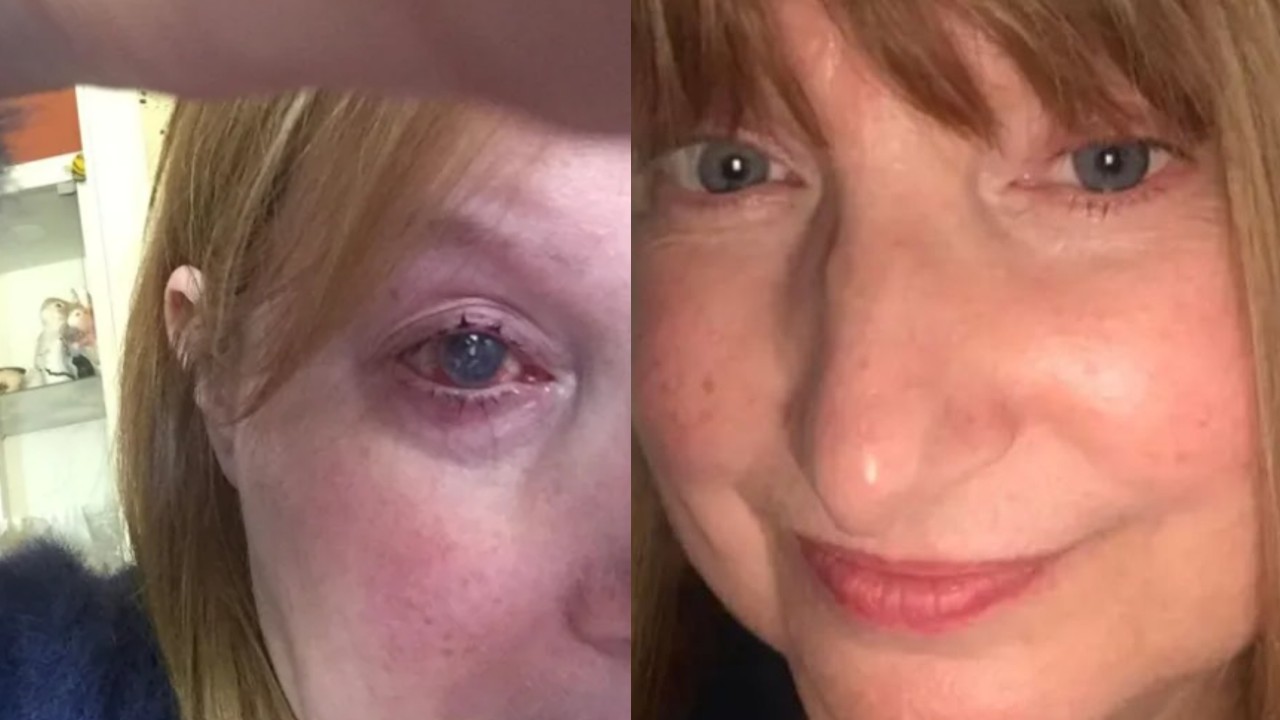 una mujer perdió un ojo tras bañarse con sus lentes de contacto puestos