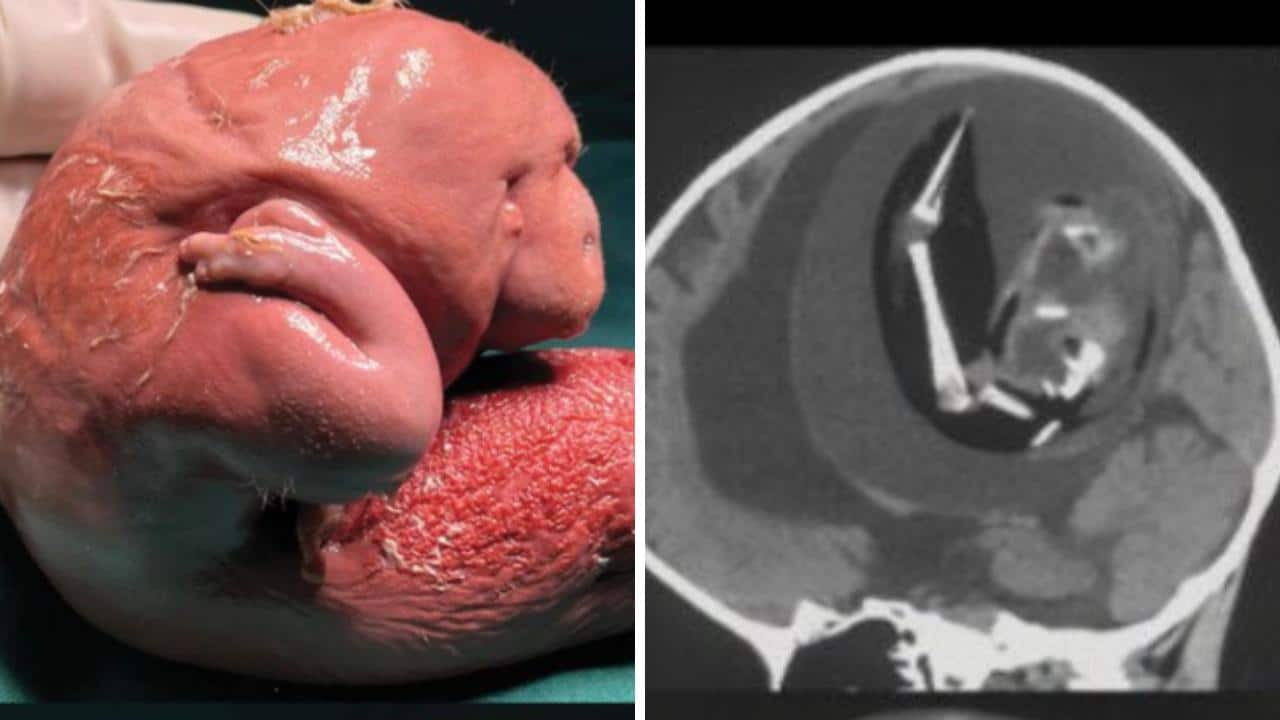 Médicos hallan un 'gemelo parásito' dentro del cerebro de una bebé
